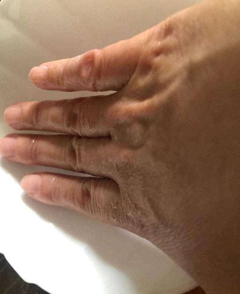 502胶水粘手上变硬了怎么有效去除？