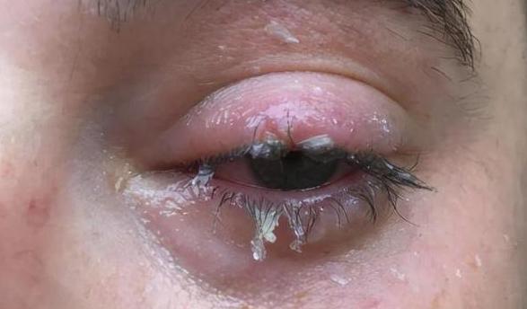 502胶水入眼处理及就医指南
