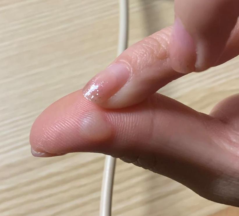 502胶水烫伤处理指南：水泡怎么办？