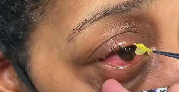 502胶水入眼处理及恢复指南