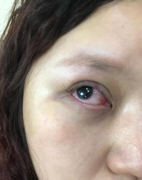 502胶水入眼应急处理及护理指南
