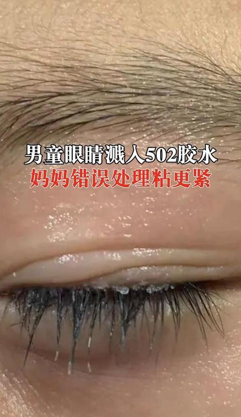 502胶水入眼紧急处理指南